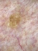 Seborrheic keratosis, dermoscopy