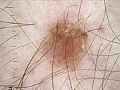 Seborrheic keratosis and intradermal naevus, dermoscopy