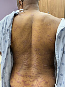 Plaque psoriasis on a man's back