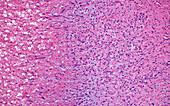 Organising blood clot, light micrograph