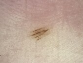 Parallel furrow pattern in mole, dermoscopy