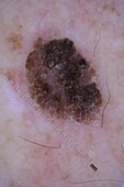 Seborrheic keratosis, dermoscopy