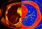 Healthy lungs, CT-PET and CT scan