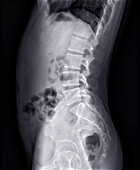 Lumbar spine, X-ray