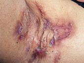 Hidradenitis suppurativa