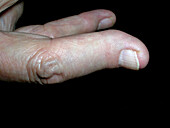 Psoriatic arthritis
