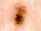 Mole on the sole of the foot, dermoscopy