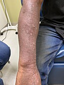 Delusional infestation during treatment