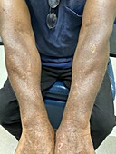 Delusional infestation during treatment