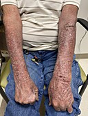 Delusional infestation and contact dermatitis