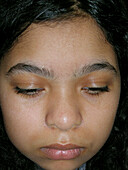 Improving vitiligo
