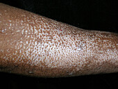 Salt and pepper pigmentation in scleroderma