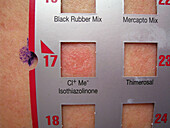 Positive allergy test