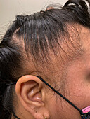 Female pattern hair loss