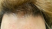 Frontal fibrosing alopecia