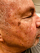 Lentigo maligna melanoma