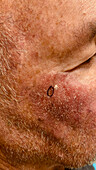 Lentigo maligna melanoma during treatment