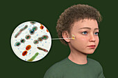 Otitis media in a child, illustration