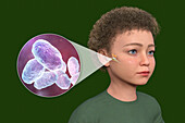 Otitis media in a child, illustration