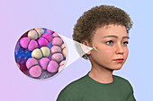 Otitis media in a child, illustration