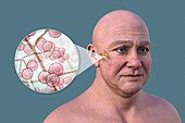 Otitis media in a man, illustration