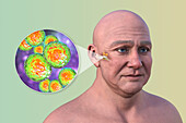 Otitis media in a man, illustration