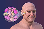 Otitis media in a man, illustration