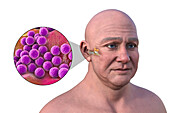 Otitis media in a man, illustration