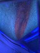Erythrasma skin infection under ultraviolet light