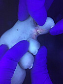 Erythrasma, ultraviolet light examination