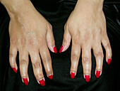 Swan neck deformity in psoriatic arthritis