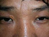Xanthelasma