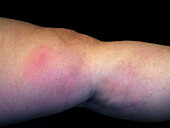 Erythema nodosum