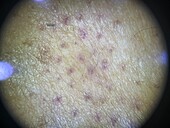 Delusional infestation, dermoscopy