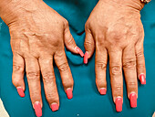 Psoriatic arthritis