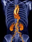 Torso blood vessels, 3D CT scan