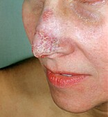 Lupus erythematosus on the nose