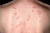 Lupus erythematosus on the back