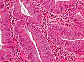 Colon adenoma, light micrograph