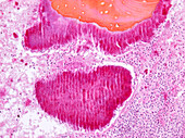 Actinomycosis bone infection, micrograph