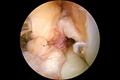 Ruptured knee ligament, endoscopy