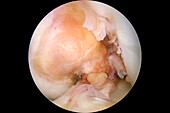Ruptured knee ligament, endoscopy