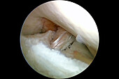 Repaired ruptured knee ligament