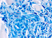 Atypical mycobacteria infection in AIDS