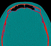 Normal frontal sinus, CT scan