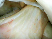 Normal ACL knee ligament, arthroscopy