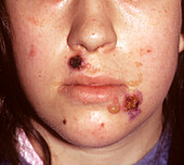 Pemphigus vulgaris lesions