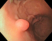 Colon polyp, endoscope view