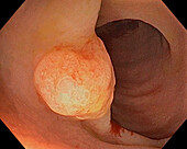 Colon polyp, endoscope view