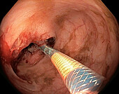 Rectal cancer biopsy, endoscope view